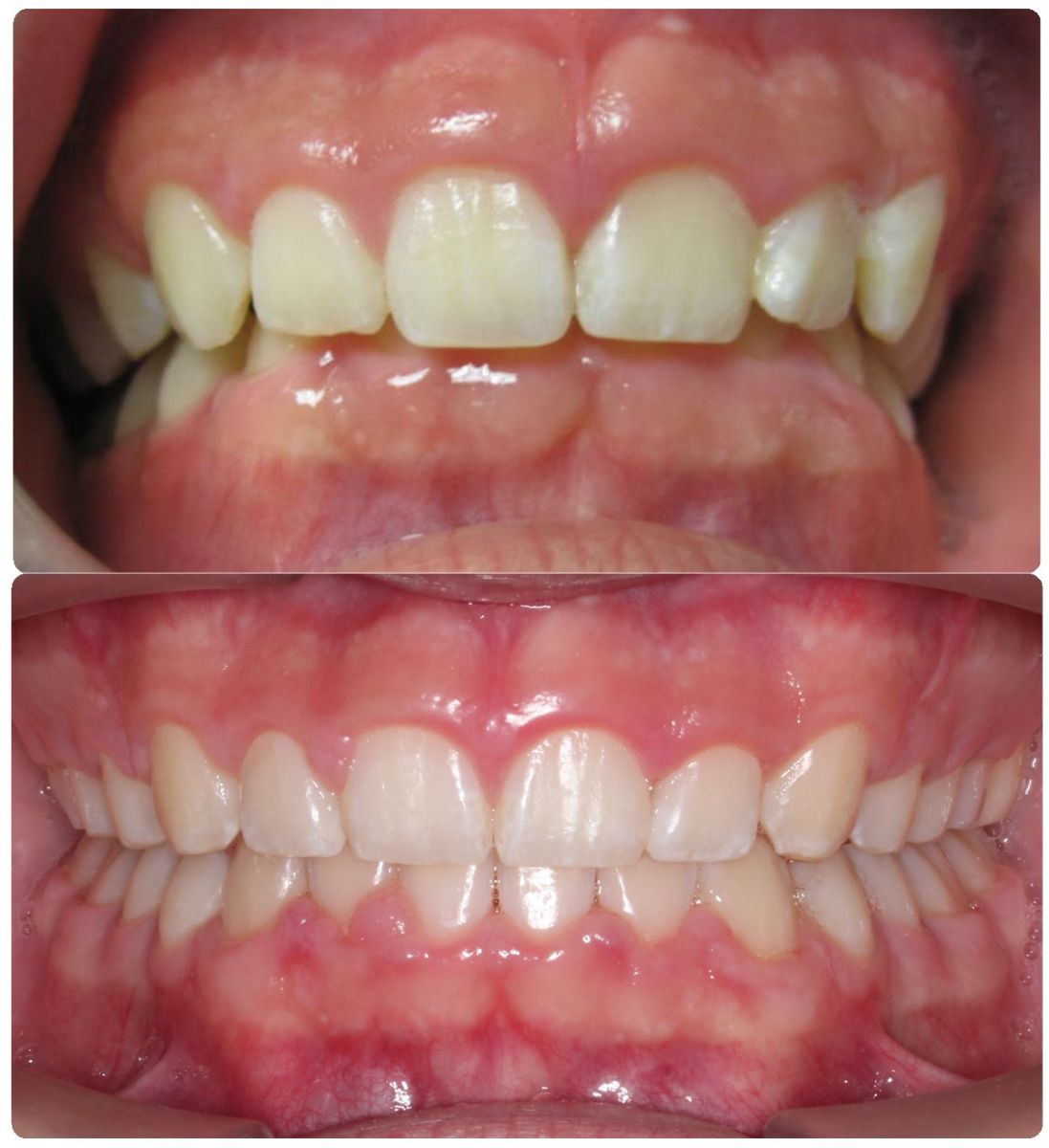 Before and After Douglas Dental Roseville CA
